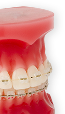 home-braces-img