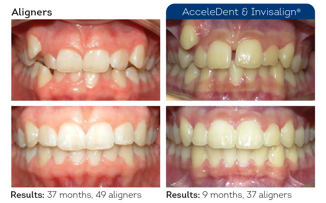 AcceleDent & Invisalign