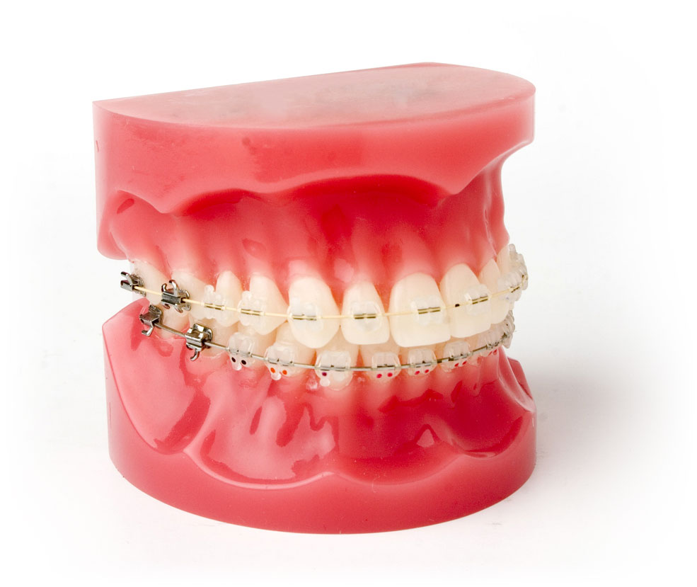 Parts of Braces  Innovative Orthodontic Centers
