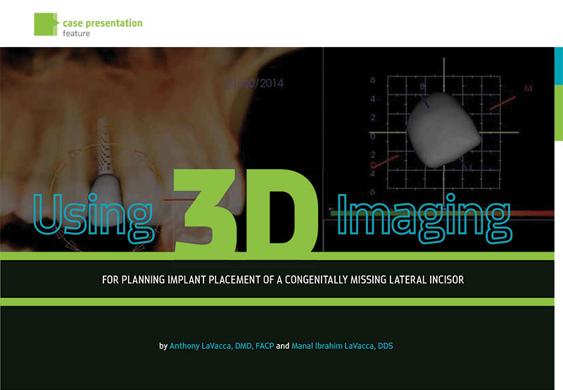 implant-placement-using-3D-scanner