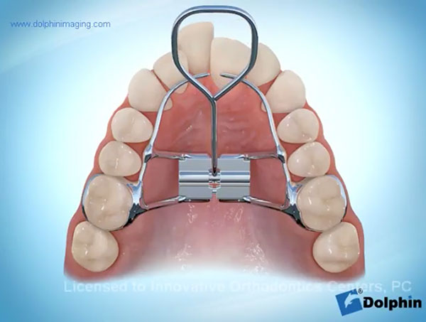 Hyrax-Rapid-Palatal-Expansion-Braces-After-video