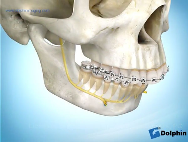 Mandibular-Advancement-with-Genioplasty-video