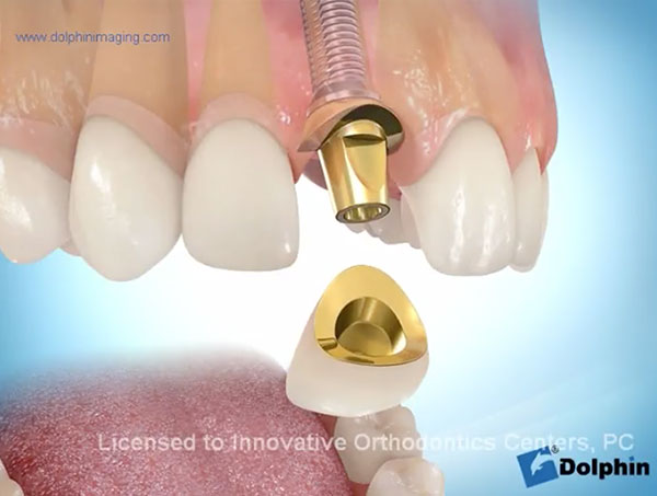 Anterior-Tooth-Implant-video