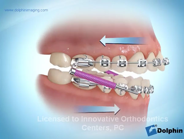 BBC-Bite-Corrector-video