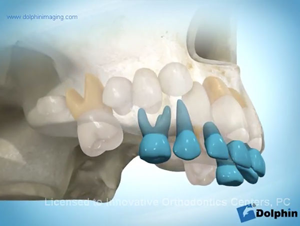 Early-Loss-Primary-Second-Molar-video