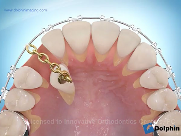 Impacted-Cuspid-Palatal-Treated-video