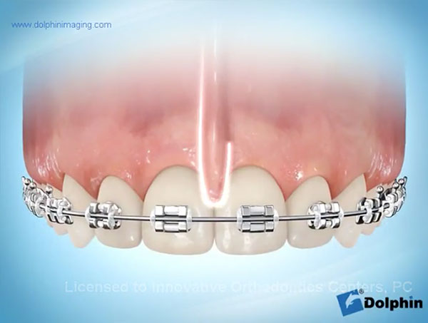 Labial-Frenectomy-after-space-closure-video