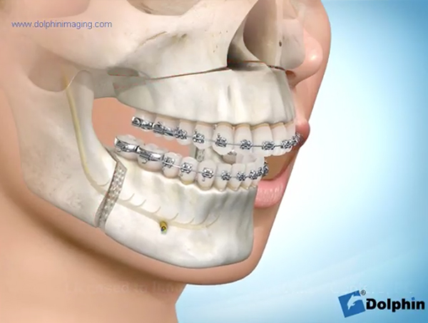 Maxillary-Posterior-Impaction-with-Mandibular-Advancement