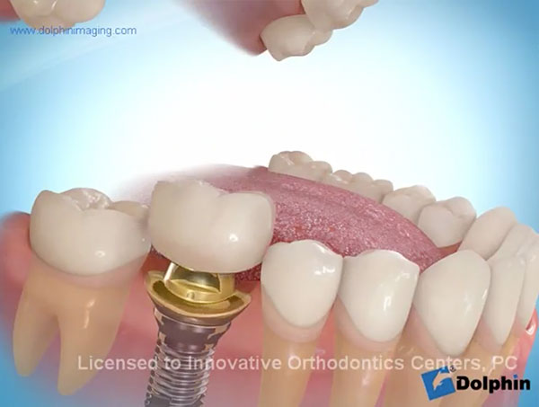Single-Posterior-Tooth-Replacement-Implant-video