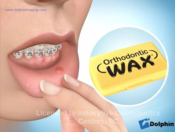 orthodontic-wax