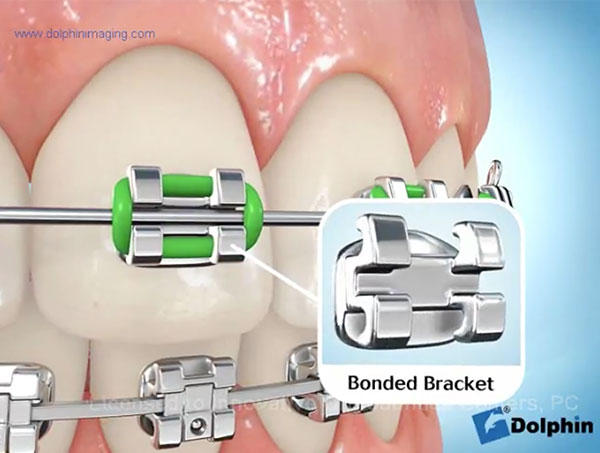 part-of-braces-video