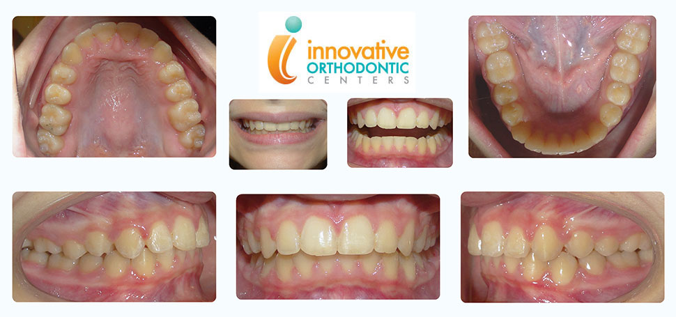 suresmile-Katerine-after