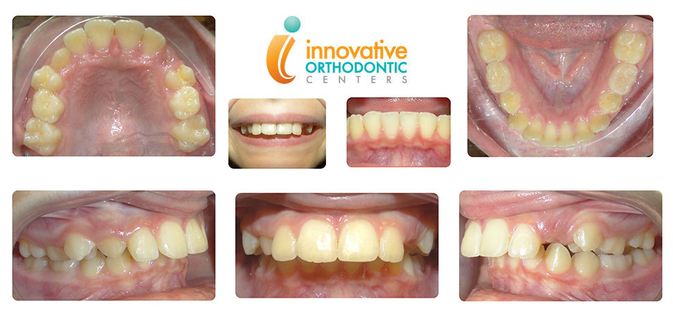 suresmile-Katerine-before