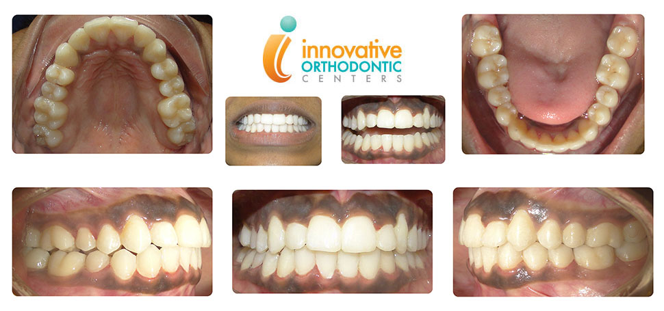 suresmile-nisha-after