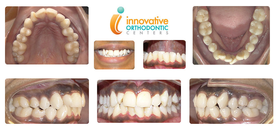 suresmile-nisha-before