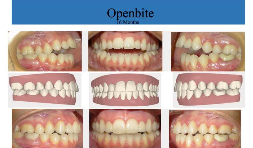 open bites