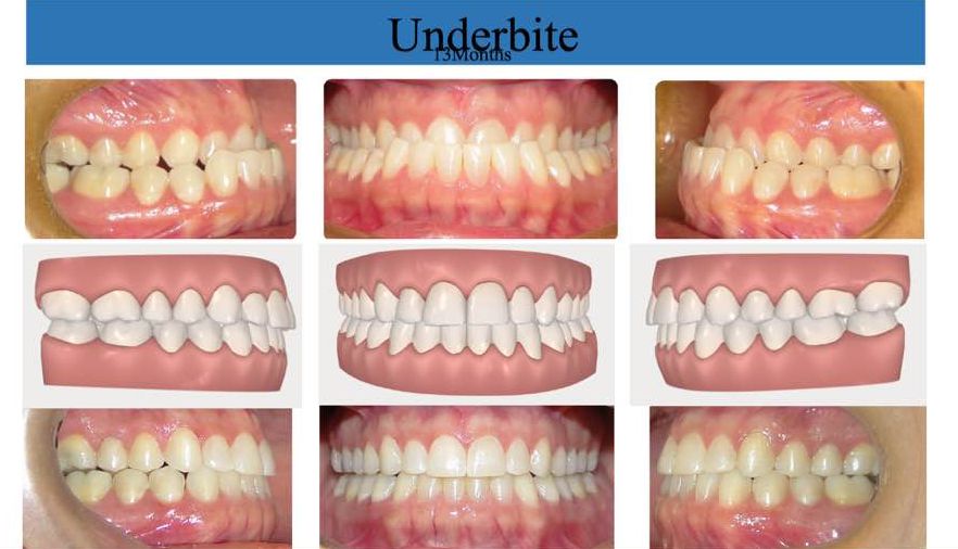 Overbite Braces Change Face Shape Before And After 2022 