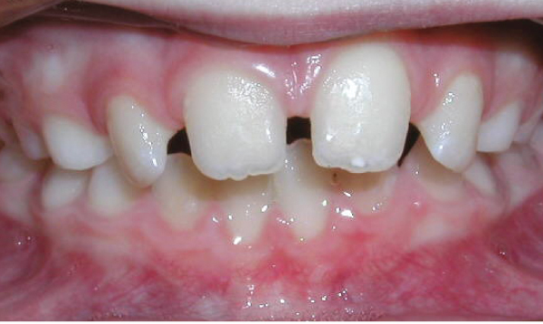 Diastema