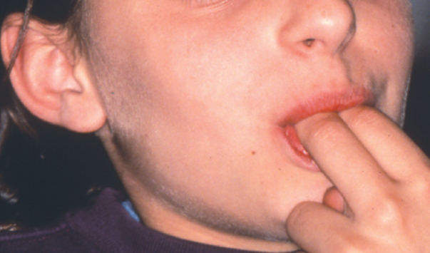 Oral Habit