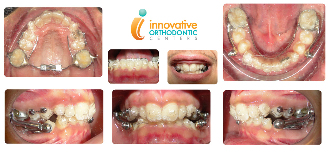 Herbst with Invisalign example before