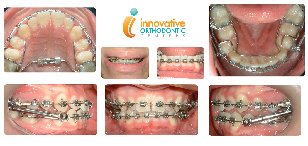 Appliances Innovative Orthodontic Centers