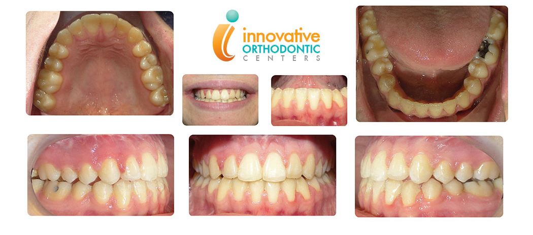 Surgical Orthodontics