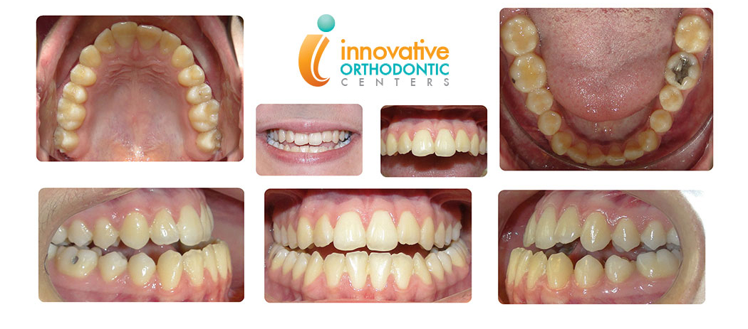 Surgical Orthodontics