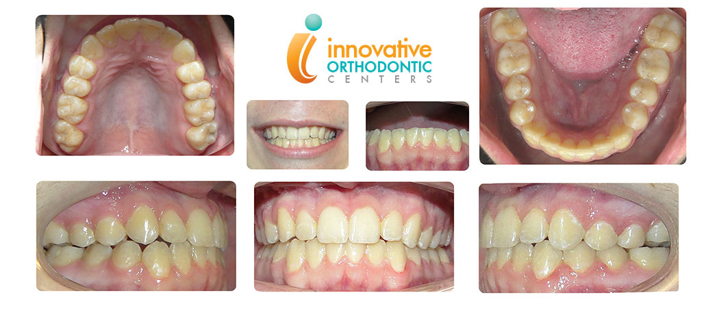 Surgical Orthodontics