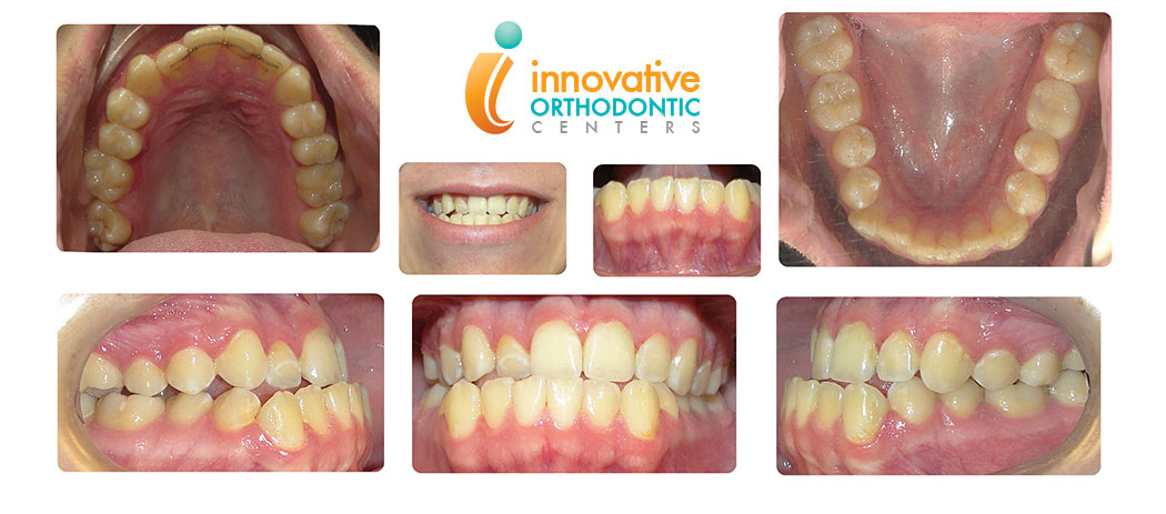 Surgical Orthodontics