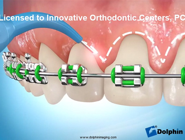 Laser Tissue Reduction