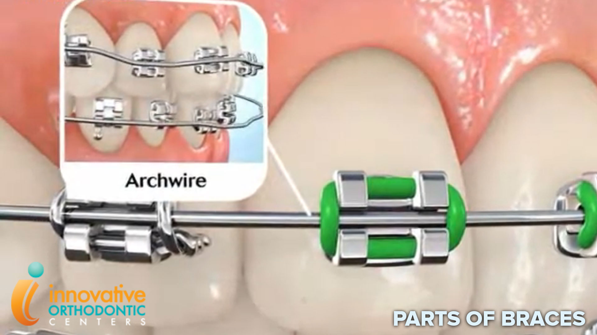 What Is A Poking Wire In Braces and Orthodontics? - ArchWired