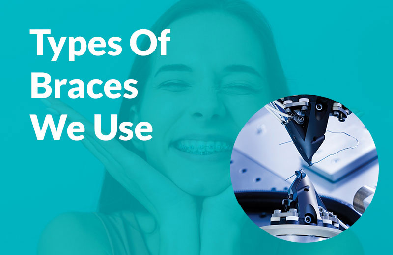 Types of Braces